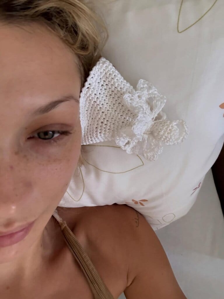 ما هو مرض بيلا حديد؟