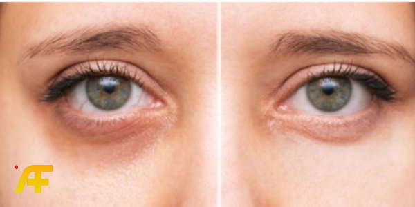 أفضل 7 طرق للتخلص من الهالات السوداء والبقع الداكنة