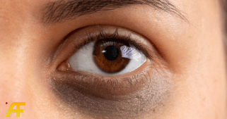 طرق للتخلص من الهالات السوداء والبقع الداكنة