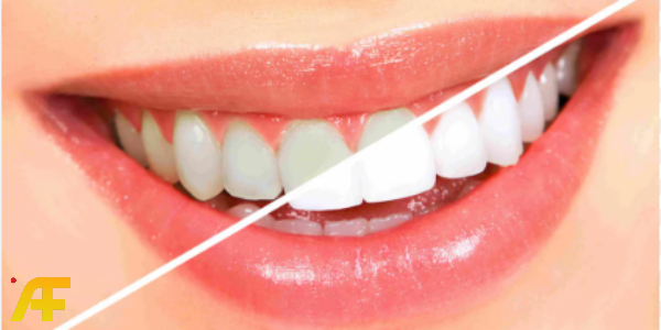 خلطات تبييض الأسنان في 5 دقائق: اكتشف سر الابتسامة المشرقة