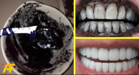 تبييض الأسنان بالفحم