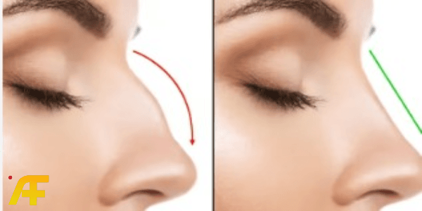 أفضل نصائح قبل عملية تجميل الأنف حسب توصيات جراحي التجميل