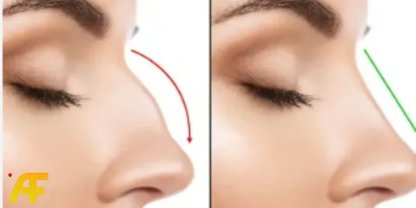 أفضل نصائح قبل عملية تجميل الأنف حسب توصيات جراحي التجميل