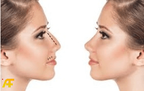 هل عملية تجميل الأنف مؤلمة