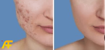 كيف يمكن علاج آثار حب الشباب؟