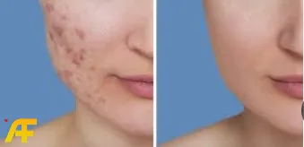 كيف يمكن علاج آثار حب الشباب؟