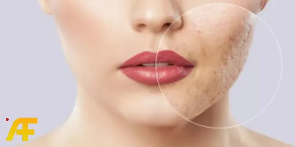 كيفية علاج حب الشباب والندبات في المنزل بطرق وعلاجات فعالة