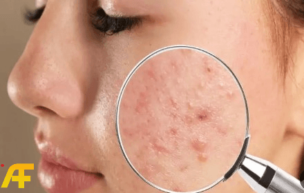 كيفية علاج حب الشباب والندبات في المنزل