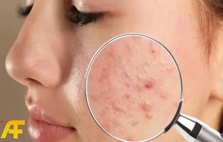 كيفية علاج حب الشباب والندبات في المنزل