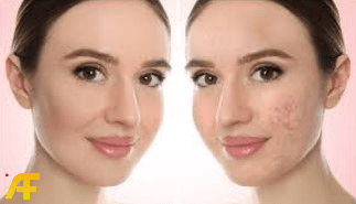 ما هي أسباب ظهور حب الشباب؟