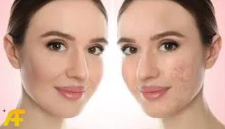 ما هي أسباب ظهور حب الشباب؟