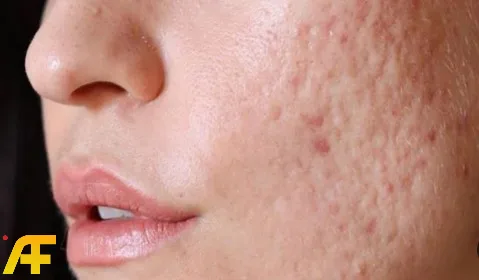 ما هي أفضل ماسكات طبيعية لعلاج حب الشباب والندبات؟